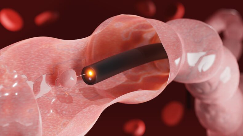 New NCI-funded project targets polyp recurrence to prevent colon cancer New NCI-funded project targets polyp recurrence to prevent colon cancer