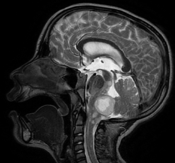 Study led by Monroe Carell Jr. Children’s Hospital at Vanderbilt looks at international cohort with rare cancer