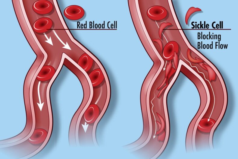 Sickle cell disease heightens risk for precancerous blood disorder