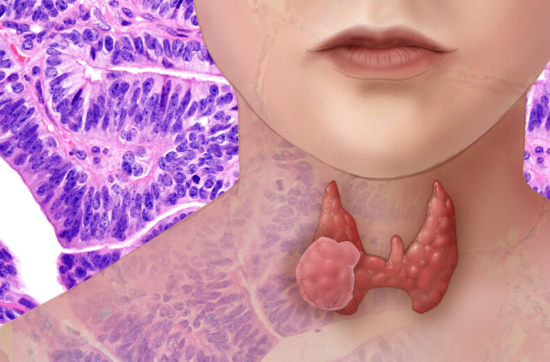 Thyroid cancer ‘atlas’ points to cell types that contribute to disease progression